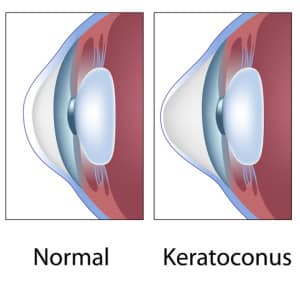Keratoconus | Takle Eye Group