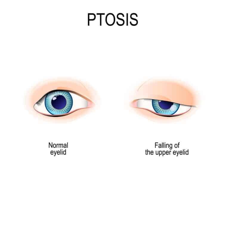 what-is-ptosis-ptosis-griffin-ga-ptosis-locust-grove-takle-eye