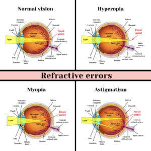 Descriptions of Refractive Errors